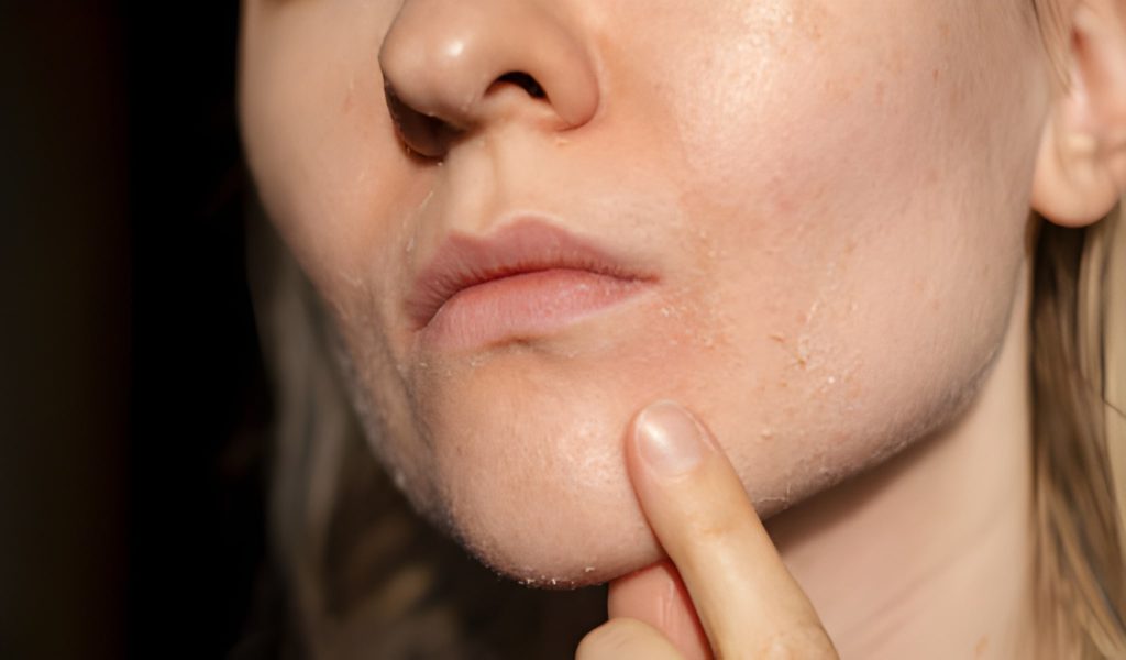 7 روش ساده برای کنترل خشکی پوست صورت در هوای خشک